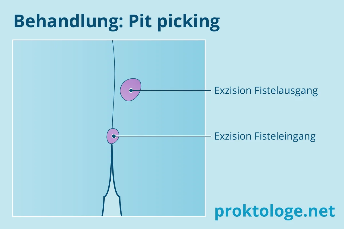 Sinus Pinolidalis Pit-Picking